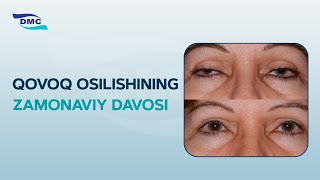 Qovoq osilishining zamonaviy davosi