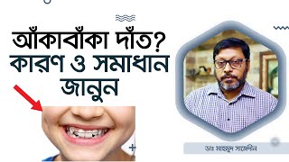 আঁকাবাঁকা দাঁত কেন হয়? সঠিক সমাধান জানুন। Malocclusion: Classes, Definition \u0026 Treatment