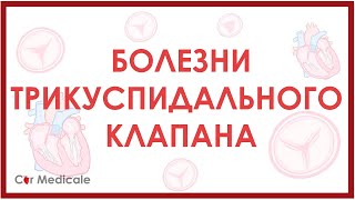 Болезни трикуспидального клапана. Пролапс, стеноз, регургитация.