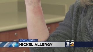 Dr. Max Gomez: Nickel Allergy