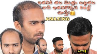 hair transplantation తల మొత్తం బట్టతల రావడం జరిగింది ఇతని రిజల్ట్ చూస్తే amazing