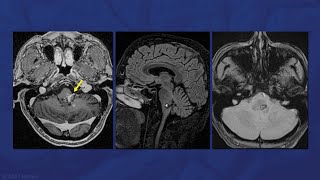 Extended Retrosigmoid Approach for Retro-Olivary Medullary Cavernous Malformation