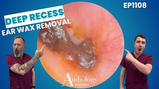 DEEP Ear Wax Removal - EP1068