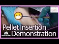 Hormone Pellet Insertion | Full Demonstration [Viewer Discretion Advised]