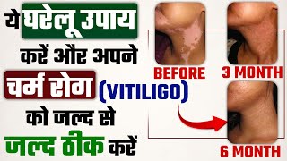 ये घरेलू उपाय करेंगे चर्म रोग (vitiligo) को जल्द से जल्द ठीक | 3 home remedies for vitiligo disease