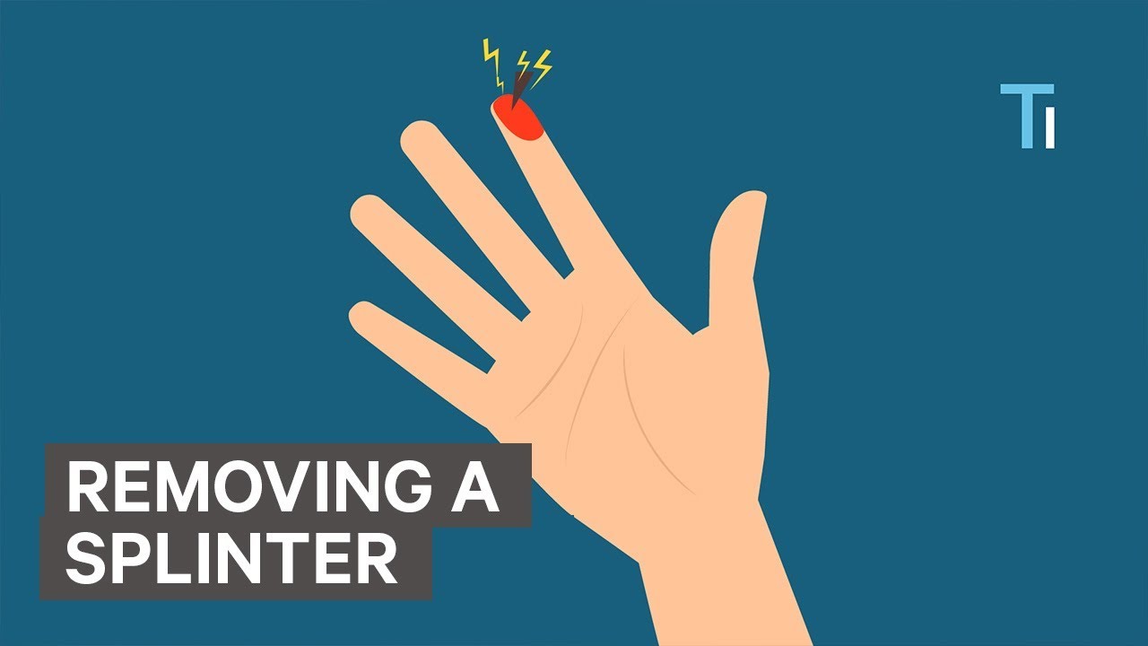 How To Remove A Splinter Youtube