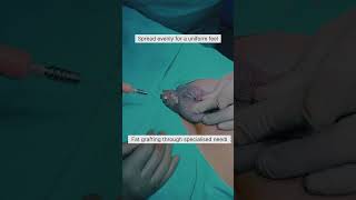 Penile enlargement surgery with fat grafting #Penilelengthening #Suspensoryligamentrelease