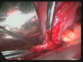 big ovarian cyst tah with bso hysterectomy