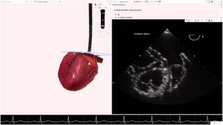 HeartWorks WATCHMAN® Left Atrial Appendage Closure Device Windsock