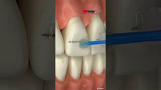 TUTORIAL: “Instalación de BRACKETS estéticos”