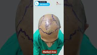 Results of Hair Transplant FUT + FUE Combination Technique | Dr. Amit Gupta