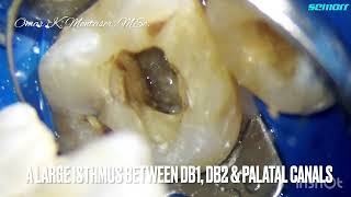 How to clean a long Isthmus between Distobuccal \u0026 Palatal Canal in an upper first molar