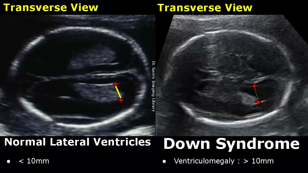 Fetal Ultrasound Normal Vs Down Syndrome | Soft Markers In Fetus For ...