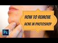 Remove Acne Skin or Pimples in Photoshop