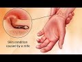 Causes Symptoms and Treatment of Scabies Causes Symptoms and Treatment of Scabies