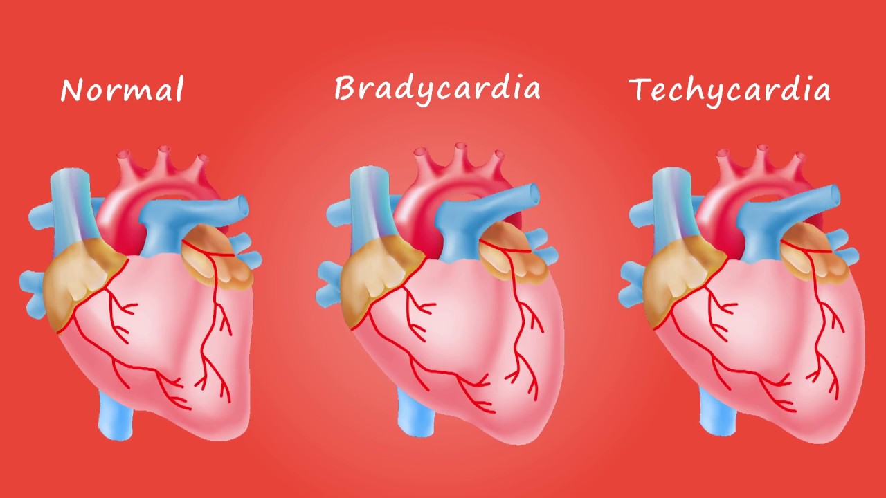 Tachy Bradycardia Syndrome Icd 10 At Zachary Hockett Blog