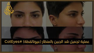 مركز  الدكتور طارق قبطي | عملية تجميل: شد الجبين بالمنظار عيون القطة CatEyes