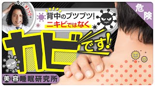 【背中ニキビ 治し方】背中ニキビの原因はカビでした！背中ブツブツの治し方はコレだ！