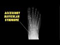 BEST Exercises for Accessory Navicular Syndrome