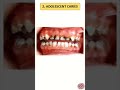 dental caries dental dentistry dentist dentaleducation caries