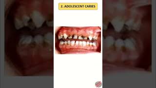 Dental caries #dental #dentistry #dentist #dentaleducation #caries