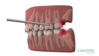 Wisdom teeth - Lapointe dental centres