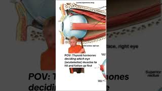 Did you know that elevated thyroid hormones can trigger binocular vision dysfunction (BVD)? 🧐 When