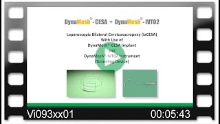 DynaMesh®-CESA /-IVT02 - OR-Video: LaCESA - Cervicosacropexy - Bilateral Fixation - Laparoscopy