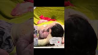 Miracle Baby - Thanatophoric Dysplasia