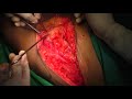 Thoracodorsal artery perforator flap