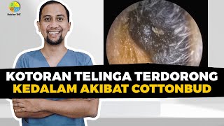 Kotoran Telinga Terdorong Kedalam Akibat Cottonbud | Dokter Tht