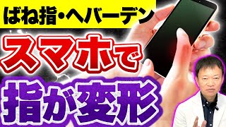 【あなたの指も変形してるかも】日常に潜む危険⚠️元に戻れなくなる「スマホ指」とは？（ばね指・へバーデン結節・リウマチ・関節痛）