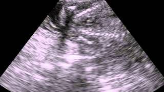 Angel's Ultrasound Scan