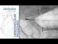 Inferior Vena Cava (IVC) Filter Placement (Eric K. Peden, MD, M. Mujeeb Zubair, MD)