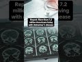 More than 7.2. million Americans living with Alzheimer's disease, report finds #shorts