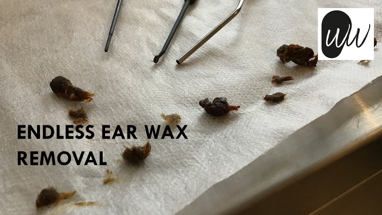 531 - Endless Ear Wax Removal | The Wax Whisperer - YouTube