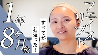 【たるみ改善】すべてが若返った！フェイスリフトから1年8ヶ月後