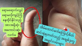 အားအရှိဆုံးအကောင်းဆုံးလက်မနှင့် အိမ်ထောင်ရေးစိတ်ညစ်ရမည့်အမျှင်လမ်းများ