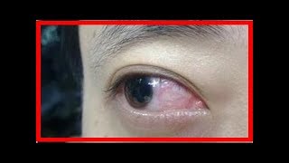 醫生警告：當你的眼睛出現這3種信號，可能是你的肝臟藏毒太多！