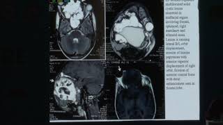 AIOC2019 Hyde Park IV  FP312   A Rare Case Report of Foster Kennedy Syndrome  Dr  Ananya Dutt