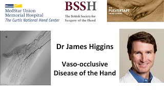 Vaso occlusive disease of the hand by Dr James Higgins