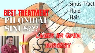 Can Pilonidal Sinus Be Cured Without Surgery? Dr Sameer Gupta, Laser & Laparoscopic Surgeon.
