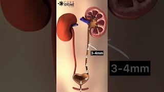 What size of kidney stone can easily pass | Treatment of Ureteric stones | How stone is removed