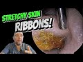 STICKY SKIN RIBBONS! 310 #ear #earwax #earwaxremoval #earcleaning #asmr #foryou #satisfying