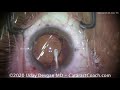 choosing toric iol steps in cataract surgery