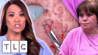 Dr. Lee Removes As Many Bumps As Possible From A Woman's Face | Dr. Pimple Popper | UNCENSORED | 18+
