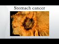 stomach cancer