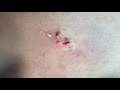 extraction satisfaction blackhead removal contour dermatology