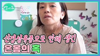 신경섬유종으로 인해 생긴 온몸의 혹 MBN 240624 방송