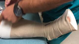 Short posterior splint